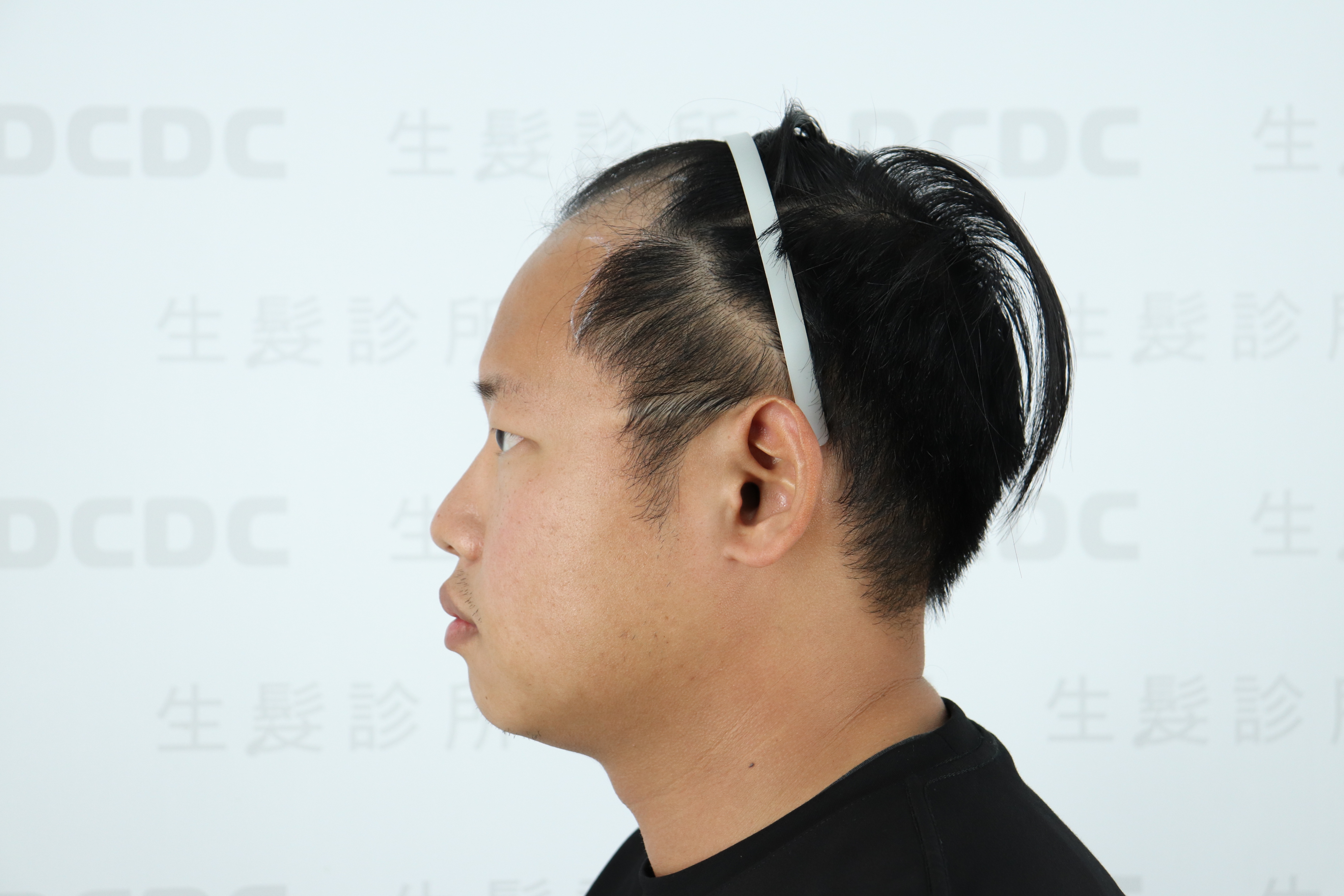 DCDC生髮診所-男性前額髮際線大範圍後退術前正面檢視